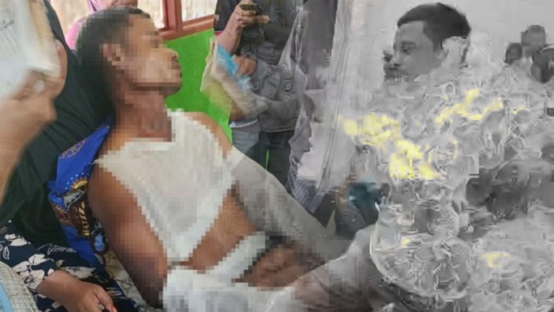 Salah satu korban yang mengalami luka bakar. (ist)